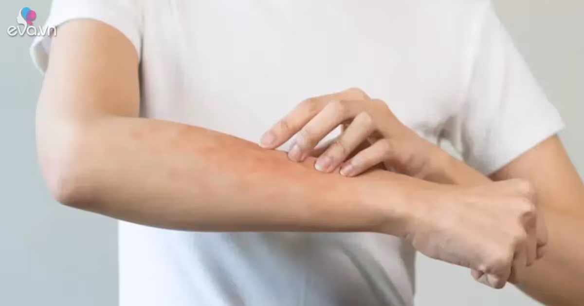 Cảnh báo viêm da sẩn ngứa do bọ chét bùng phát khi thời tiết nóng ẩm
