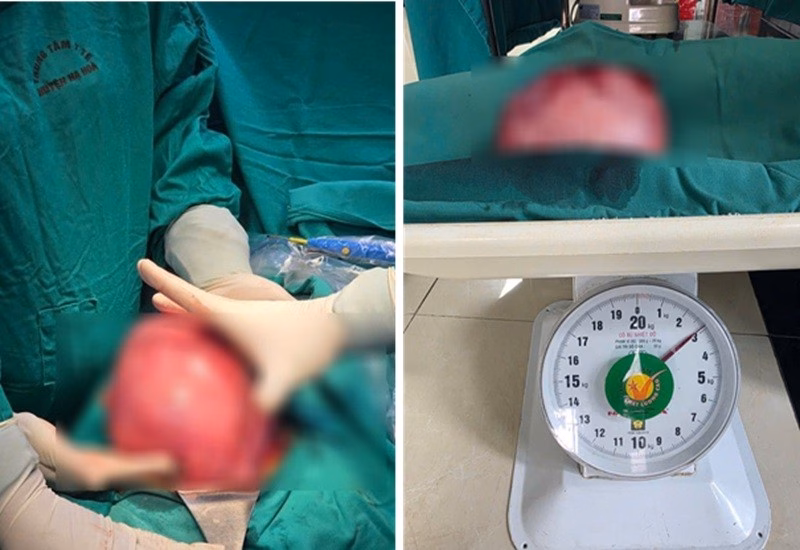 Khối u sơ tử cung của bệnh nhân N Khối u sơ tử cung của bệnh nhân N nặng gần 3kg.