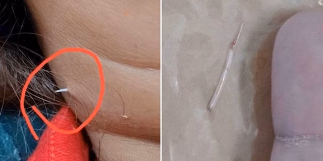 Người phụ nữ bị xương cá đâm xuyên qua da