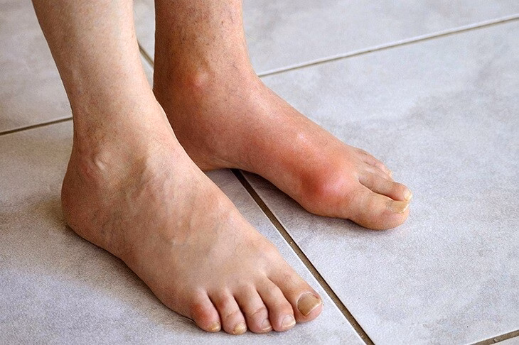 Mắc bệnh gout ở 22 tuổi, dấu hiệu cảnh báo từ đau khớp cổ chân - Ảnh 2.