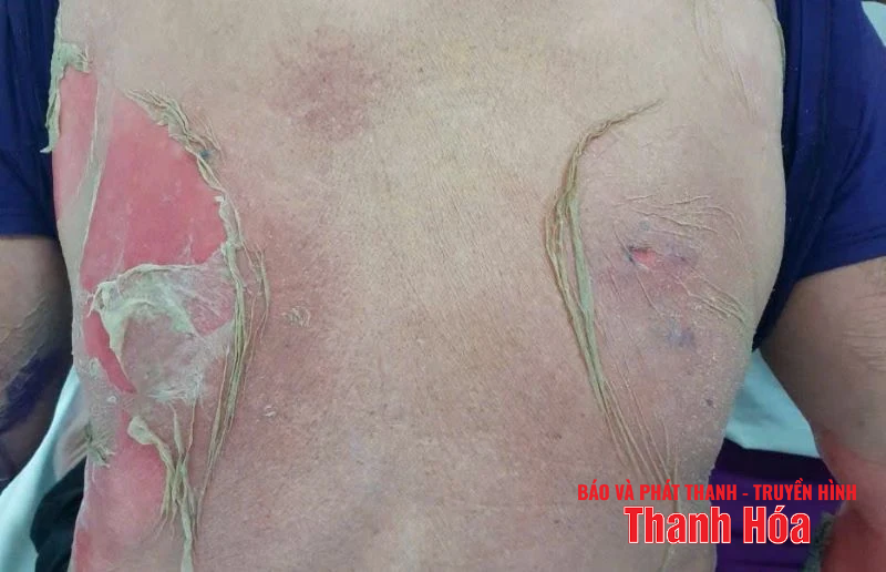 Siết chặt kiểm soát hàng giả trên không gian mạng và nông thôn Một bệnh nhân điều trị tại Bệnh viện Da liễu Thanh Hóa bị dị ứng thuốc dẫn đến hoại tử thượng bì nhiễm độc sau khi dùng thuốc mua qua mạng xã hội.