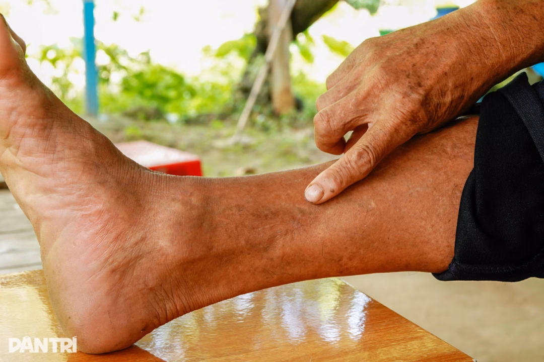 Ông Chiến chỉ vết sẹo do mảnh đạn xuyên qua chân lúc bị địch bắn (Ảnh: Bảo Kỳ).