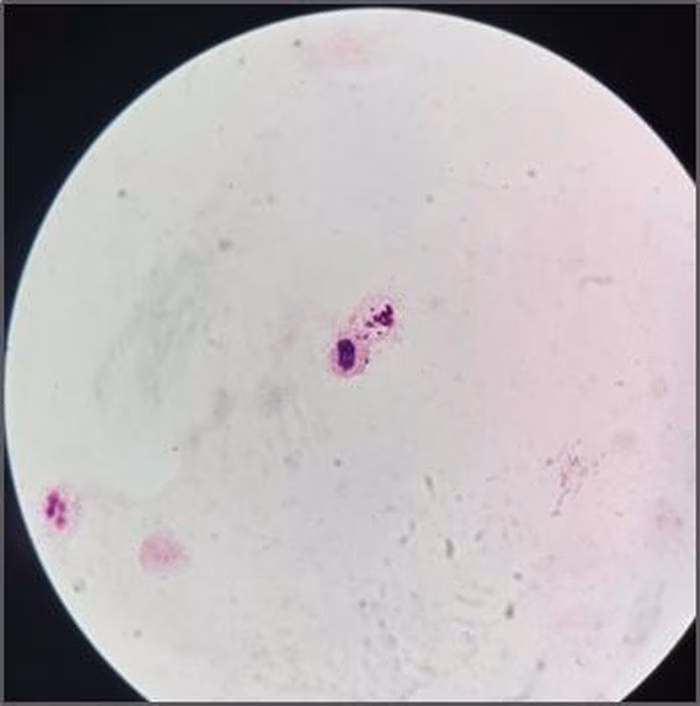 Kết quả PCR dương t&iacute;nh với Neisseria meningitidis