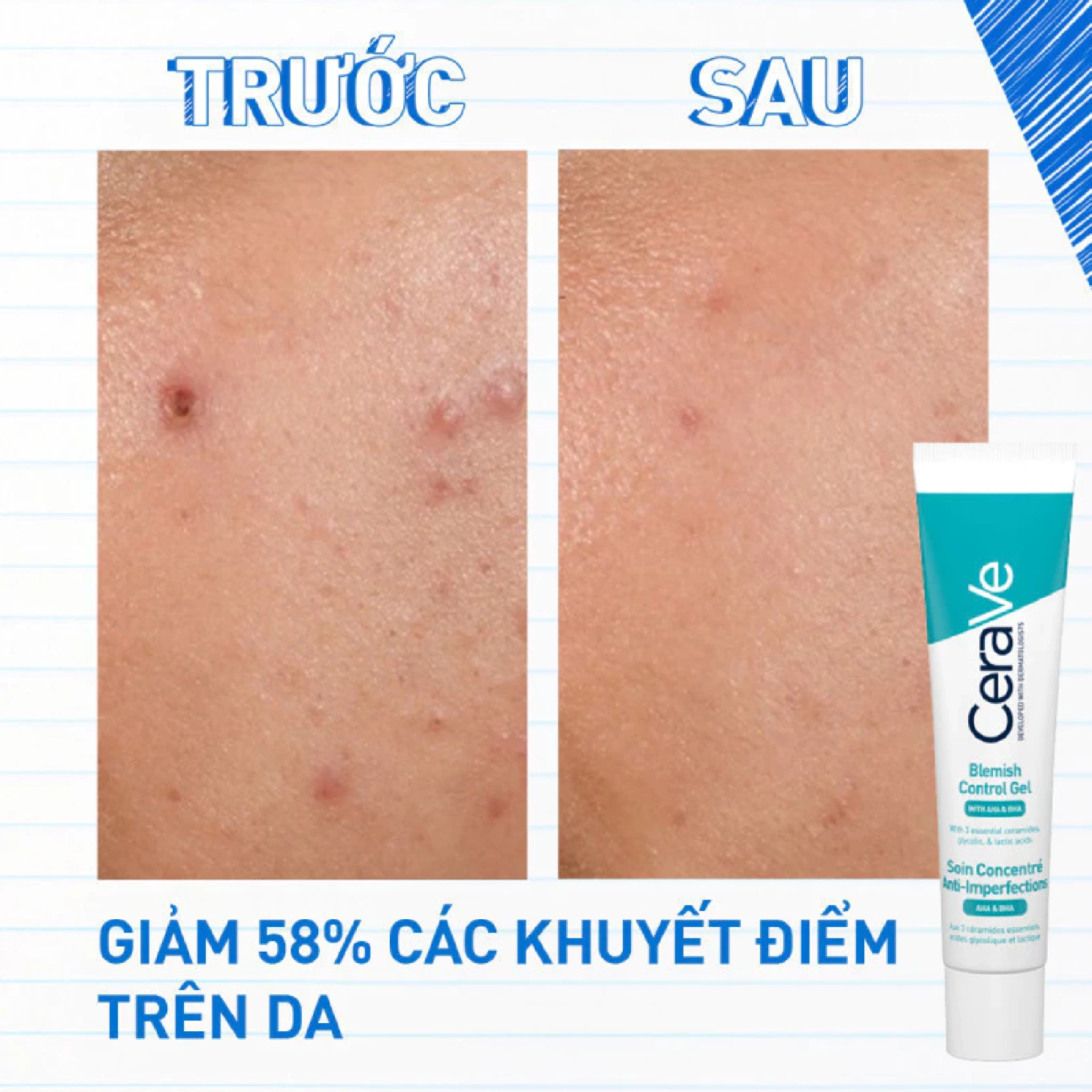 4 kem trị mụn giá rẻ nhưng cực hiệu quả cho cả mụn nặng Top 4 kem trị mụn giá rẻ mà hiệu quả với cả mụn thể nặng - Ảnh 5.
