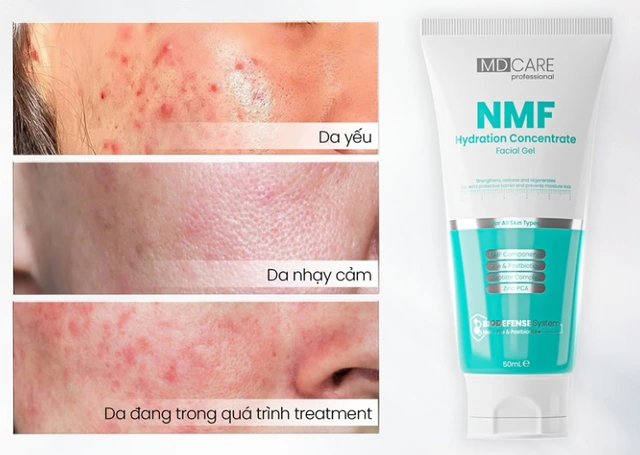 Top 5 kem dưỡng phục hồi sau trị mụn ai cũng 'mê' ngay lần đầu tiên- Ảnh 4.