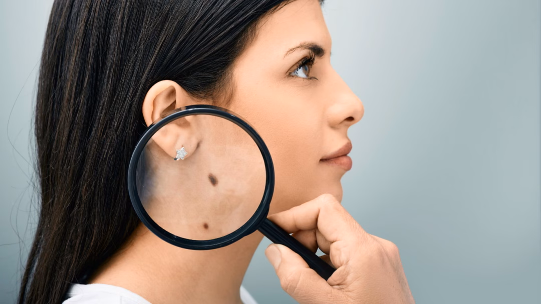 Da mới sau khi x&oacute;a nốt ruồi