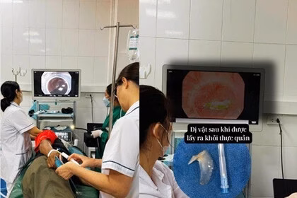 Cứu thành công một phụ nữ bị sặc hạt quất hồng bì vào đường thở