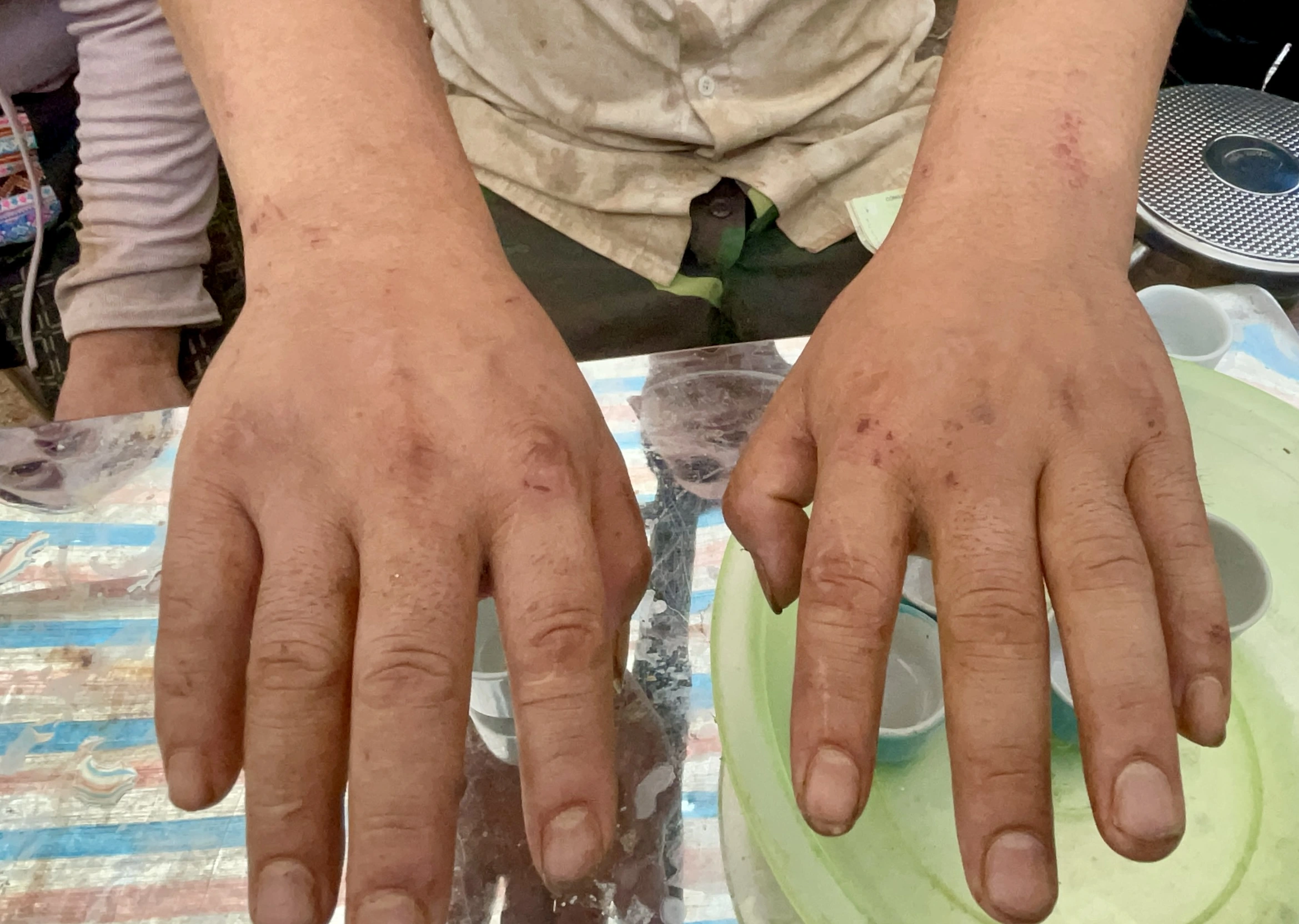 Tay của anh Ná chi chít vết xước vì đào bùn