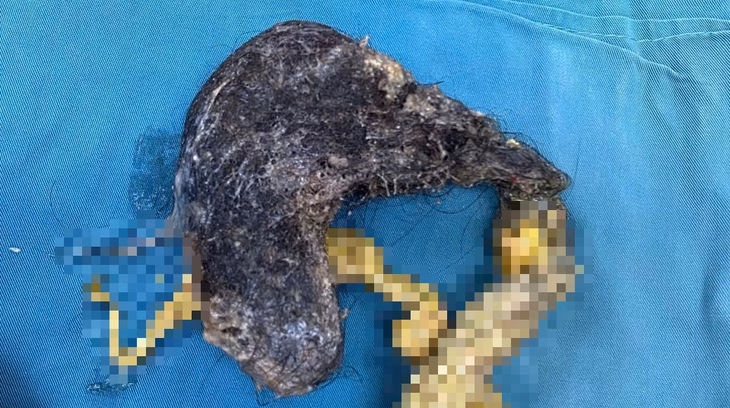 Lâm Đồng: Phẫu thuật thành công cứu bé trai bị hóc búi tóc 0,5kg trong dạ dày Búi tóc được các bác sĩ phẫu thuật gắp ra khỏi dạ dày bệnh nhân - Ảnh: Bệnh viện cung cấp