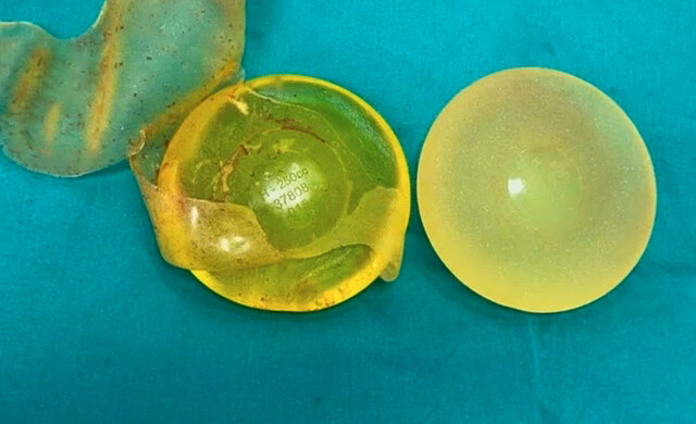 Người phụ nữ phát hiện túi ngực bị rách sau 22 năm đặt