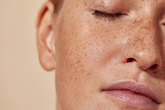 Tăng sắc tố da (hyperpigmentation) là tình trạng da xuất hiện những mảng hoặc đốm sẫm màu hơn so với vùng da xung quanh.