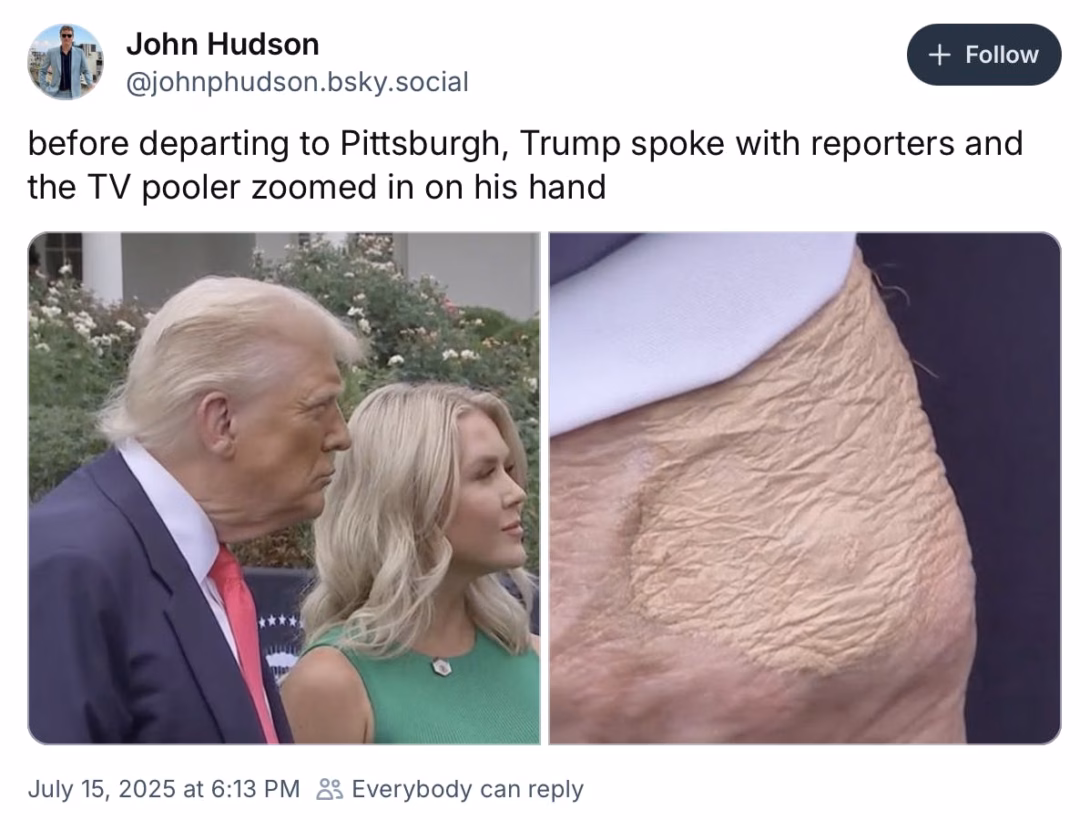 Vết bầm trên tay Tổng thống Trump gây đồn đoán Screenshot