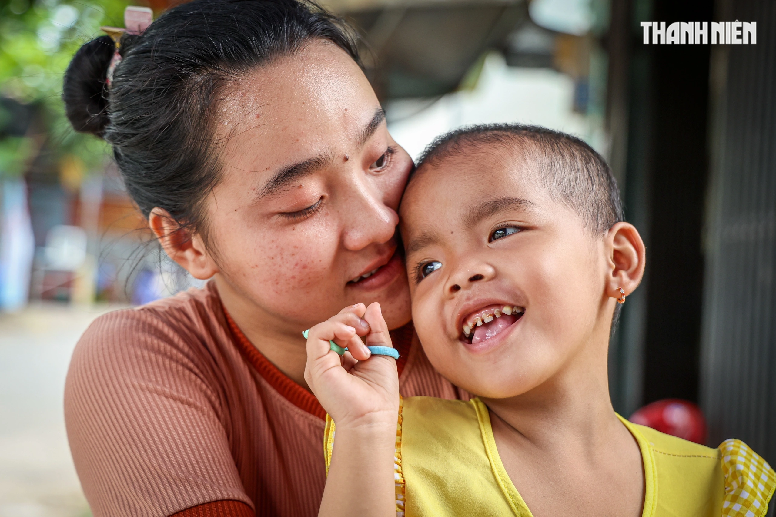 Cứu bé trai 4 tuổi trước nguy cơ mù do ung thư mắt Bé Ngọc trong vòng tay mẹ dù đang chống chọi với ung thư mắt, căn bệnh có thể cướp đi ánh sáng và tuổi thơ chưa kịp bắt đầu của con