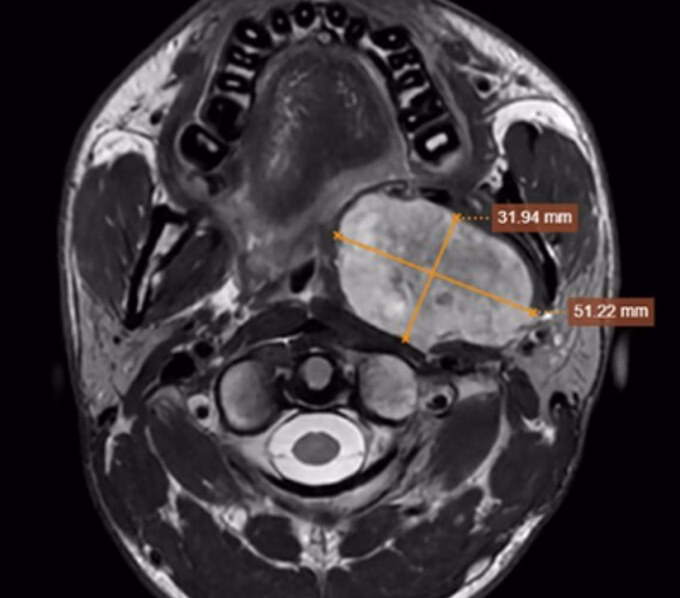 Cậu nam sinh 19 tuổi đối mặt tử vong vì khối u chèn ép dây thần kinh sọ