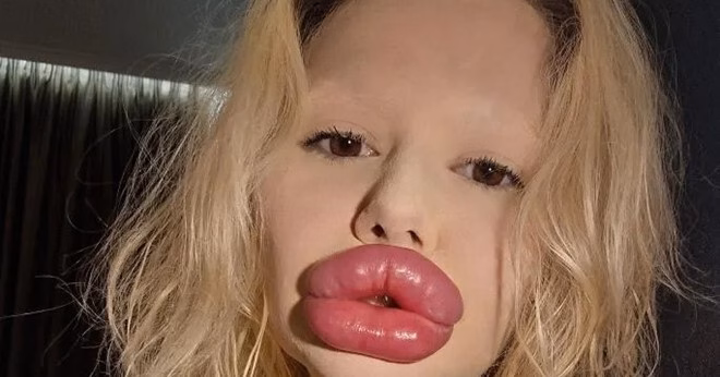 Nhan sắc ‘hot girl môi lớn’ trước và sau phẫu thuật thẩm mỹ gây sốt mạng