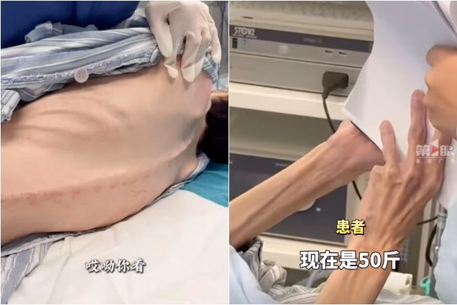 12 năm dùng thuốc giảm cân, người phụ nữ Thượng Hải bị hậu quả thảm hại