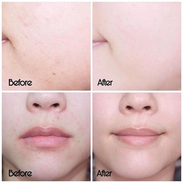 5 kem dưỡng giúp phục hồi da sau khi trị mụn hiệu quả Top 5 kem dưỡng phục hồi sau trị mụn ai cũng 'mê' ngay lần đầu tiên- Ảnh 3.