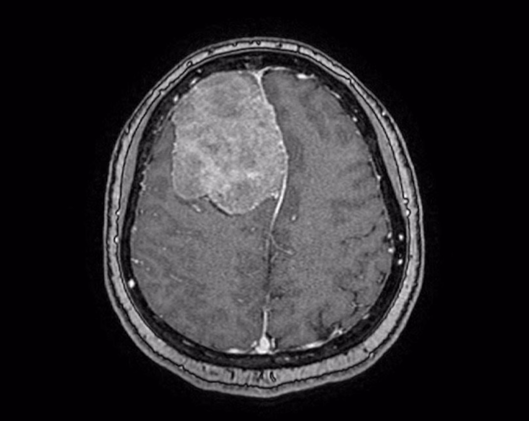 Bệnh nhân FV phẫu thuật thành công u não 6cm bằng công nghệ cao Phim chụp MRI cho thấy một khối u lớn như trái cam sành trong não phải bệnh nhân