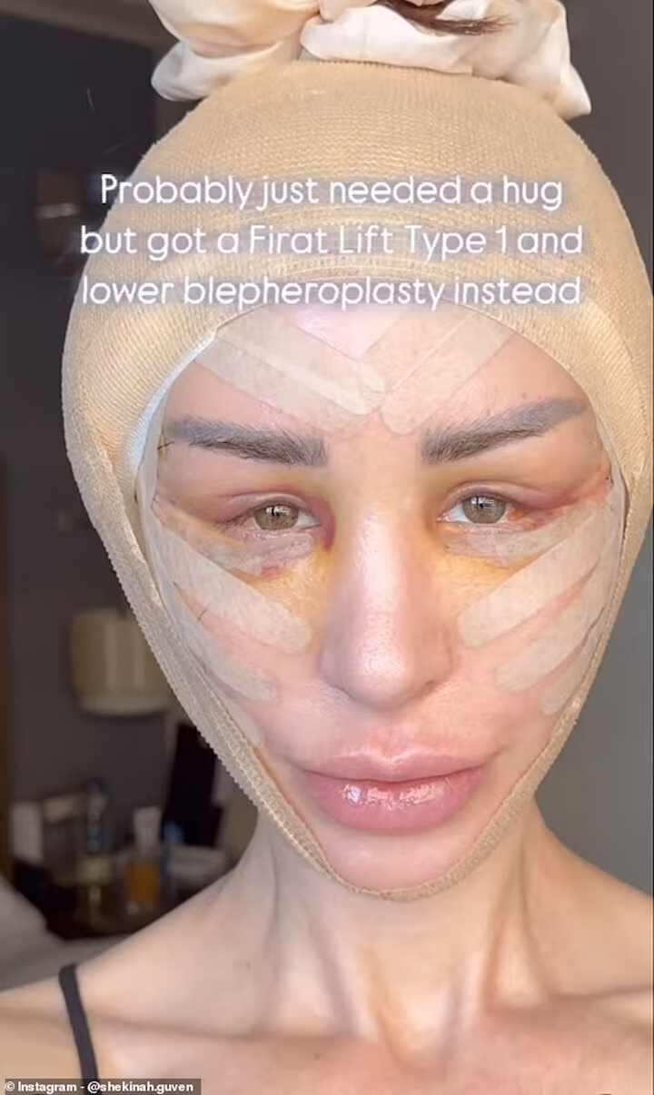 Căng mặt bằng chỉ khâu lưới – trào lưu mới gây tranh cãi trong làm đẹp