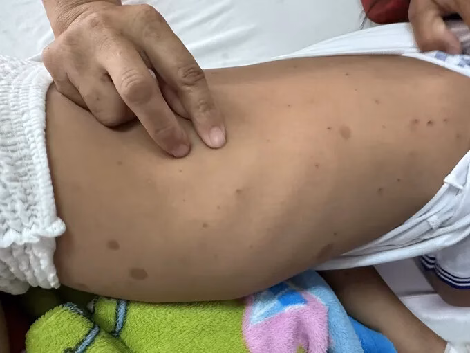 Hai trẻ em bị ong đốt nguy kịch sau khi được điều trị tại bệnh viện