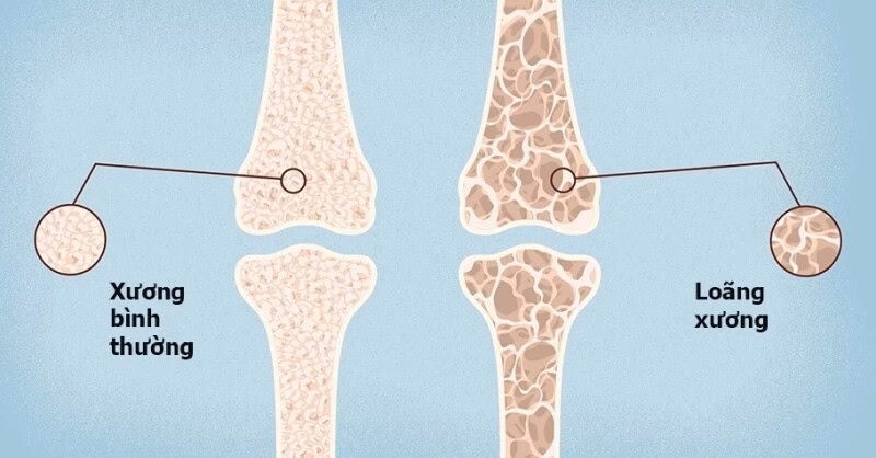 Loãng xương ngày càng phổ biến ở người trẻ: Dấu hiệu và cách phòng ngừa hiệu quả
