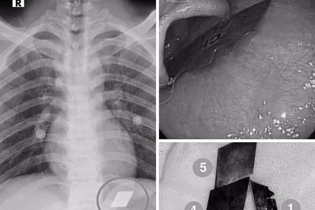 Nam thanh niên nuốt 4 lưỡi dao rọc giấy và dao lam được cấp cứu thành công