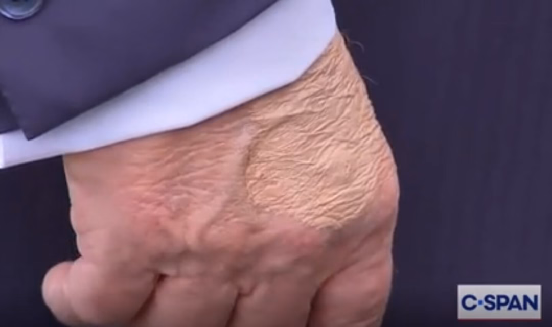 In April, Trump's bruise was seen again during a presentation ceremony for the Commander-in-Chief Trophy in Washington, D.C.