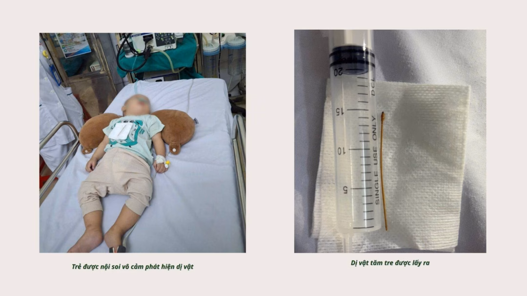 Bác sĩ gắp thành công tăm tre dài 5 cm ra khỏi dạ dày bé 7 tháng tuổi