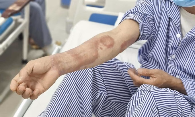 Bệnh phong có dễ lây lan?