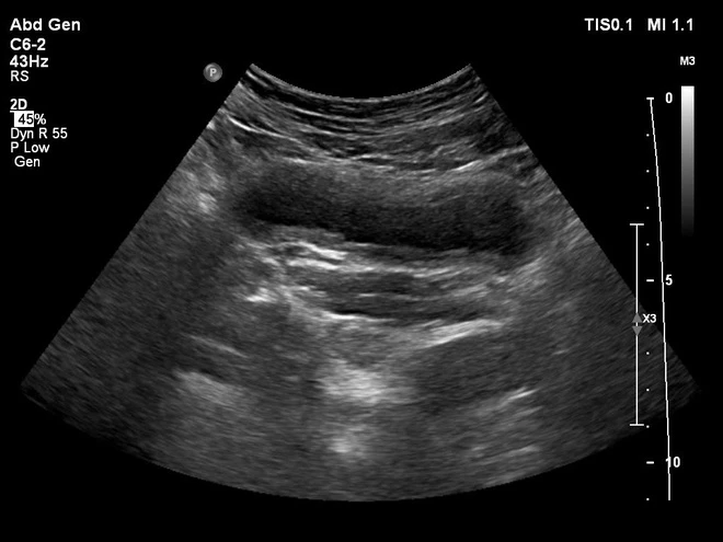 Cảnh báo: Quần bó sát gây viêm đường tiết niệu Kết quả siêu âm của bệnh nhân. Ảnh: BSCC.