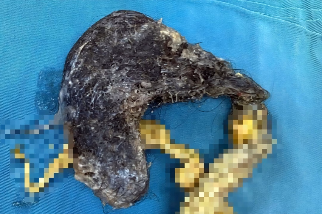 Cậu bé 5 tuổi có khối tóc 0,5 kg trong bụng được giải cứu như thế nào?