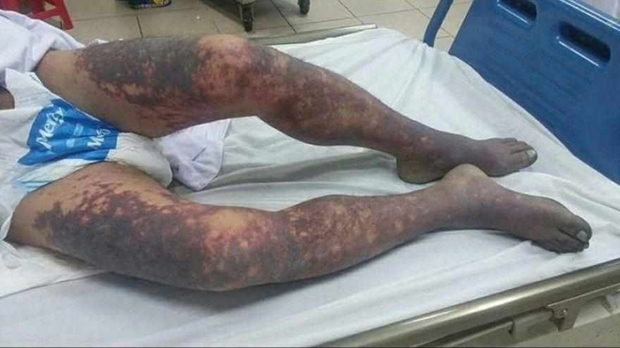 Hà Nội ghi nhận 1 ca tử vong do mắc liên cầu lợn cùng hàng chục ngàn du khách tham dự hội tụ tại Cảnh báo nguy cơ tử vong do nhiễm liên cầu lợn