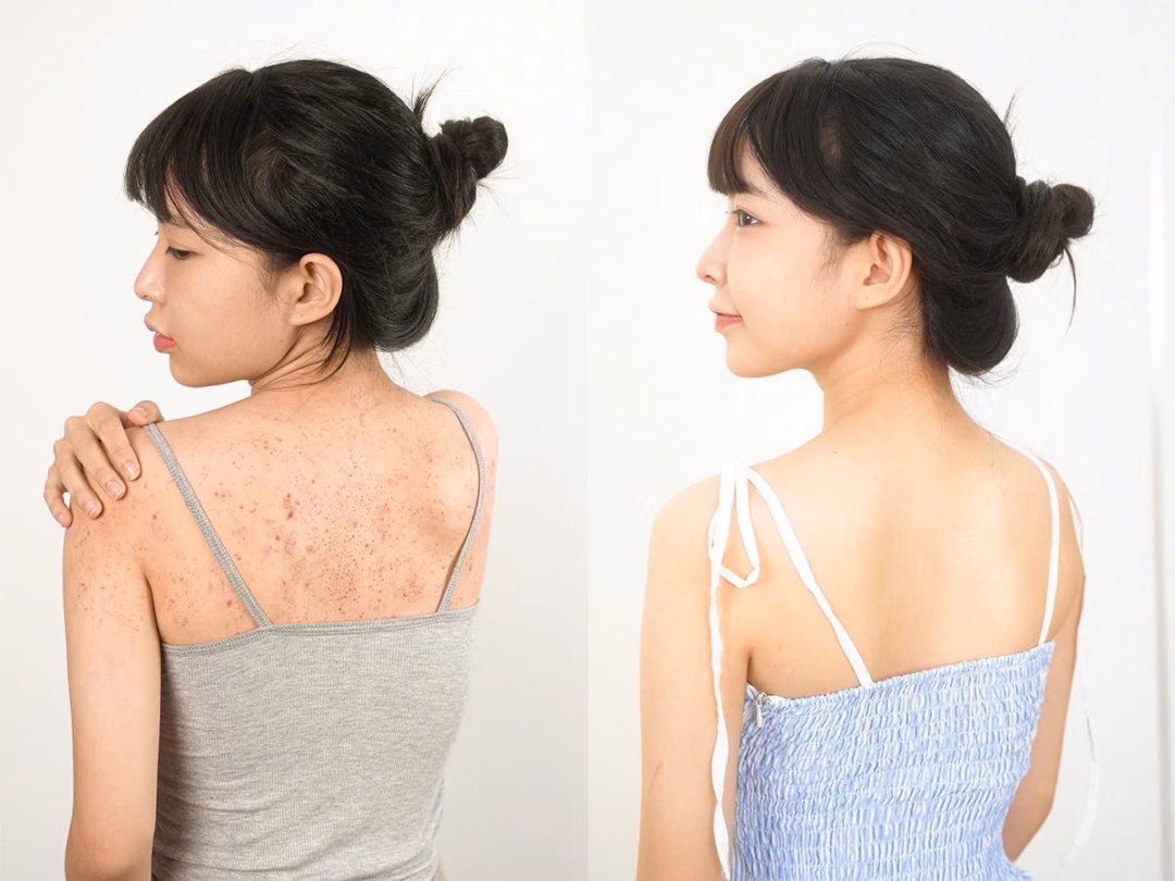 Viêm nang lông không nên chủ quan: Tìm hiểu và điều trị đúng cách