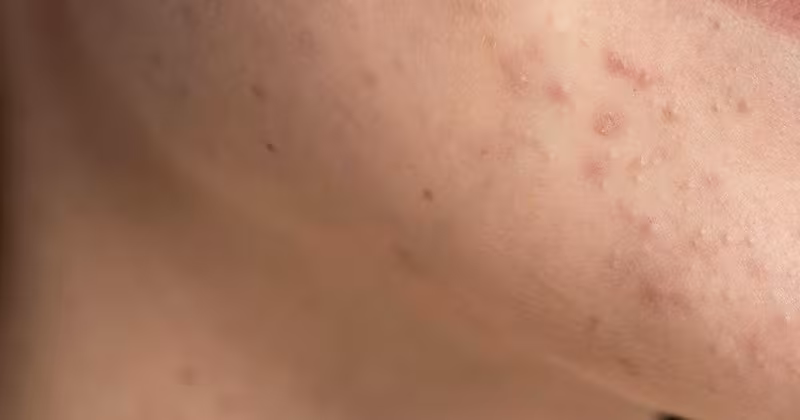 5 cách hiệu quả kiểm soát mụn do hội chứng buồng trứng đa nang (PCOS)