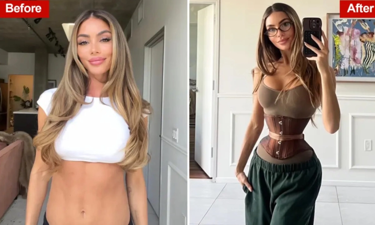 Bí mật đằng sau ‘eo con kiến’: Cắt xương sườn và kỹ thuật RibXcar gây tranh cãi tại Mỹ