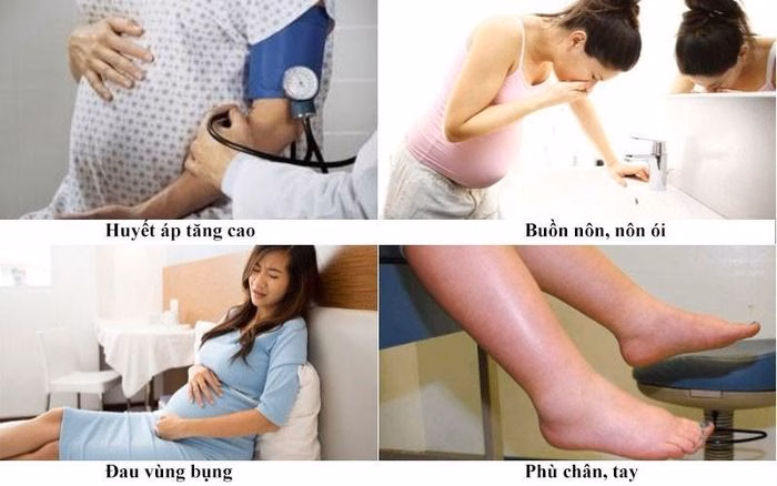 Biểu hiện tiền sản giật ở phụ nữ mang thai