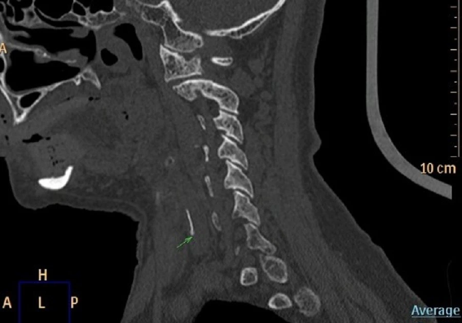 Cảnh báo: Những “mẹo” chữa hóc xương cá nguy hiểm có thể đe dọa tính mạng