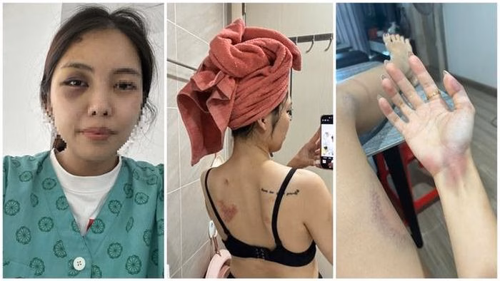 Ch&acirc;n thương bầm t&iacute;m tr&ecirc;n cơ thể chị Trang