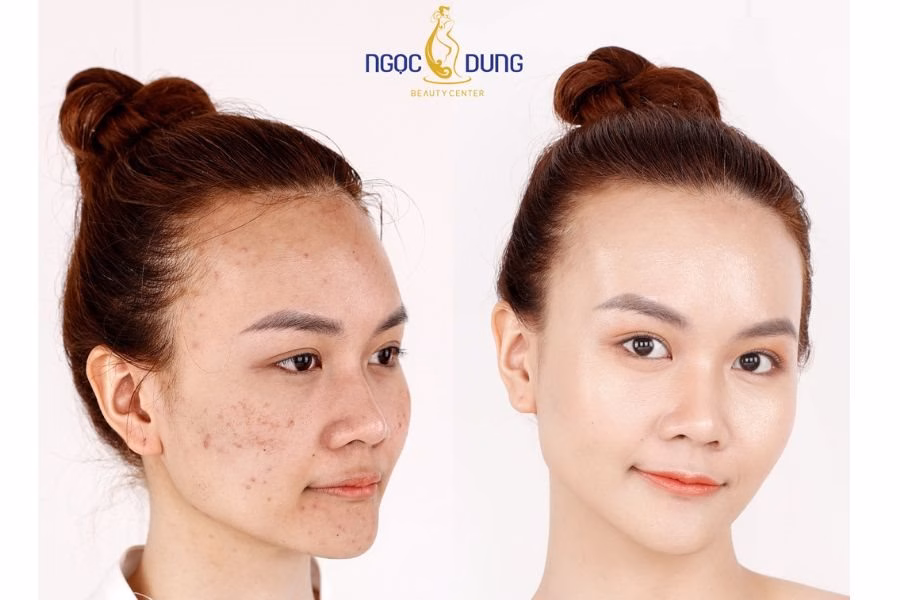 L&agrave;n da trắng mịn, kh&ocirc;ng vết th&acirc;m sau điều trị