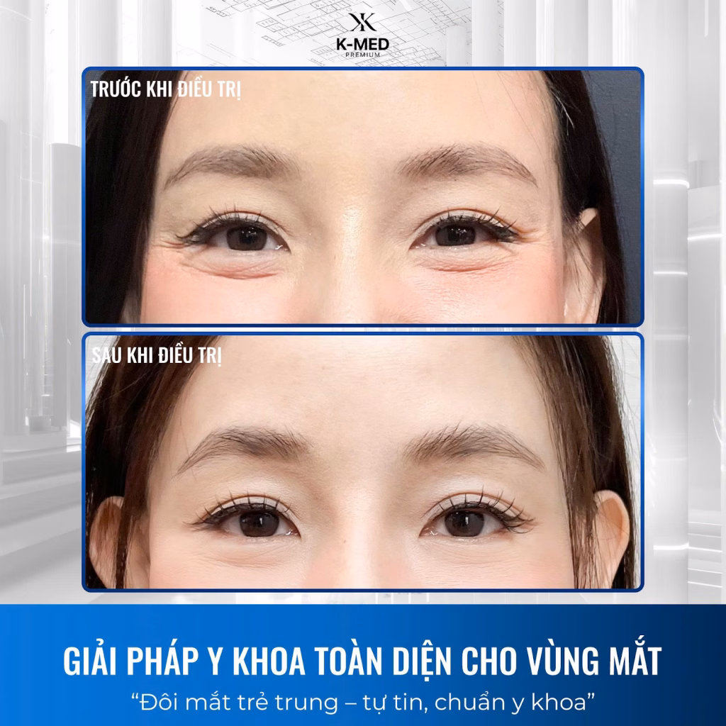 Liệu tr&igrave;nh trẻ ho&aacute; mắt tại K-MED với c&ocirc;ng nghệ laser v&agrave; RF