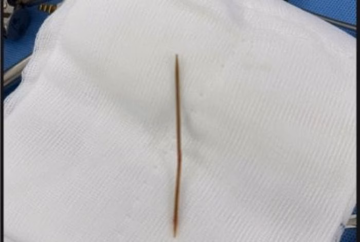 Tăm tre xuy&ecirc;n thực quản v&agrave; dạ d&agrave;y