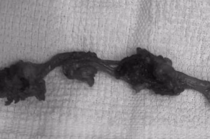 Cảnh báo nang niệu rốn: Hiểm họa từ cơn đau bụng âm ỉ dễ bị bỏ qua