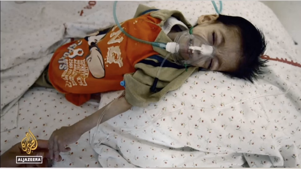 Trẻ em ở Gaza chỉ còn da bọc xương. Ảnh: The Guardian
