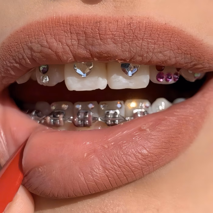 Chụp ảnh khoe niềng Chụp ảnh khoe niềng