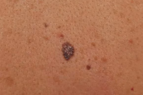Cách xử lý nốt ruồi nghi ngờ ung thư Cách xử lý nốt ruồi nghi ngờ ung thư