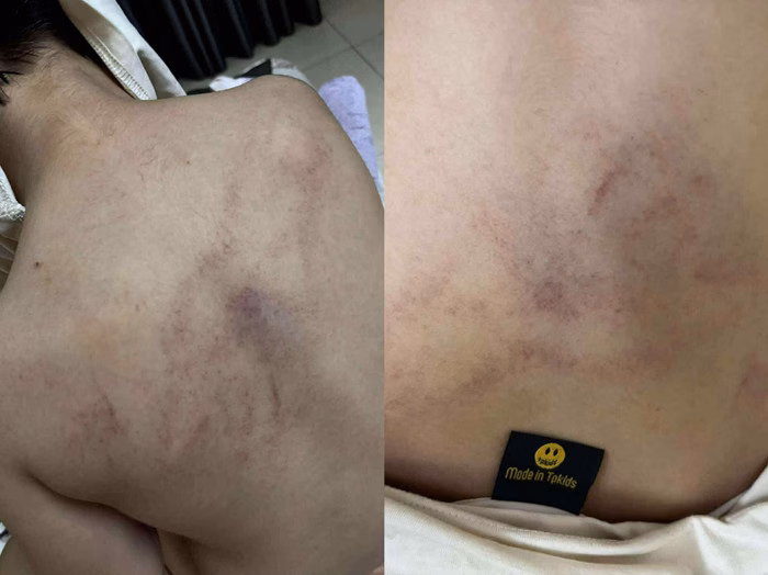 Nhiều vết bầm tím trên cơ thể bé gái