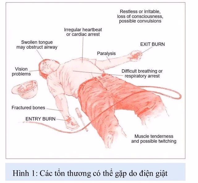 Bị điện giật ngưng tuần ho&agrave;n may mắn được cứu sống