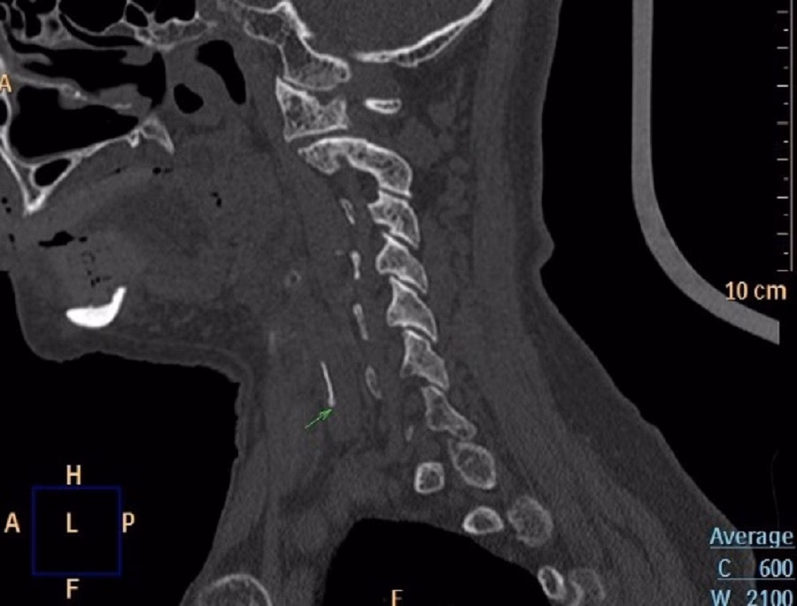 H&oacute;c xương c&aacute; g&acirc;y tổn thương tuyến gi&aacute;p