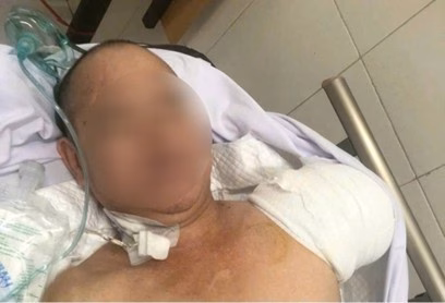 Phẫu thuật cắt cụt tay tại Bệnh viện Bạch Mai Bệnh nhân trải qua phẫu thuật cắt cụt tay