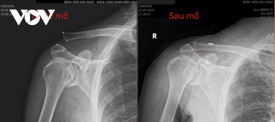Bệnh nhân 65 tuổi được phẫu thuật tái tạo dây chằng do trật khớp vai vì tai nạn giao thông Ca phẫu thuật diễn ra an toàn